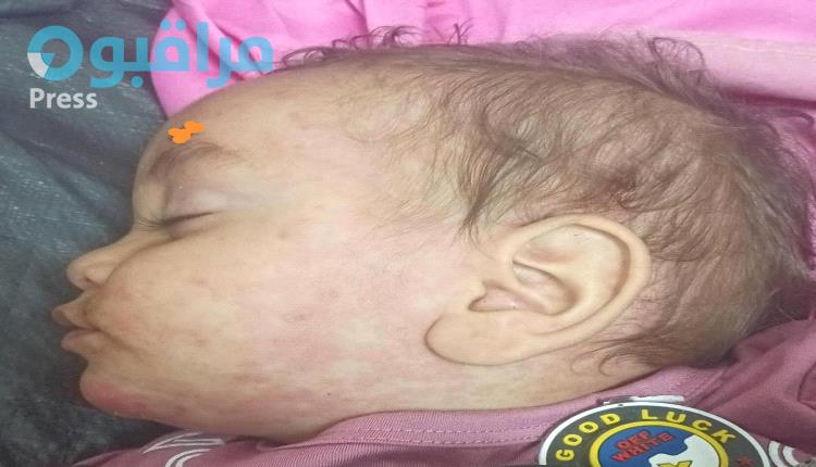 اهالي مديرية  المسيمير بمحافظة لحج يشكون من انتشار مرض تفتك بالاطفال