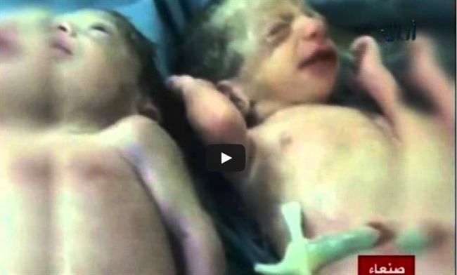 بالفيديو..وفاة طفل يمني ولد برأسين من أم أنجبته توأماً مع طفلة بصحة جيدة