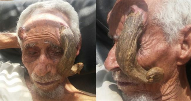 وفاة ذو القرنين أحد أكبر المعمرين اليمنيين بسوء تصرف مع قرنيه(صور)